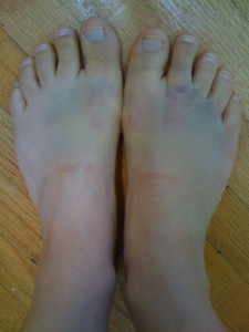 bruised-feet